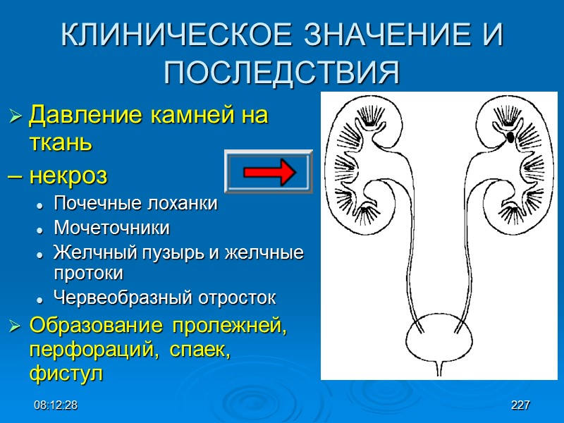 08:12:02 КЛИНИЧЕСКОЕ ЗНАЧЕНИЕ И ПОСЛЕДСТВИЯ Давление камней на ткань  – некроз Почечные лоханки